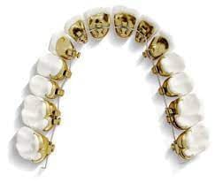Incognito tannregulering er spesiallaget til hver tann og er små gullflater som monteres på baksiden av tennene.