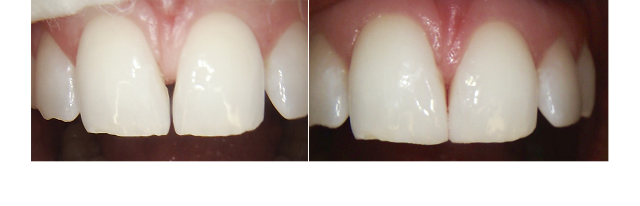 Före och efterbilder på tänder behandlade för Diastema